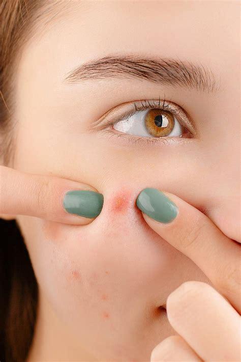 Acne