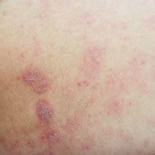 Seborrheic Dermatitis