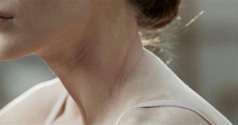 Vitiligo